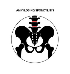 Ankylosing Spondylitis Disease