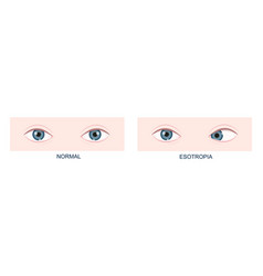 Esotropia Horizontal Strabismus Before And After