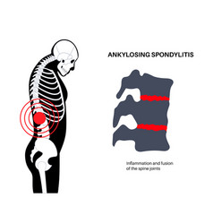 Ankylosing Spondylitis Disease