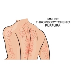 Skin Lesions In Thrombocytopenic Purpura