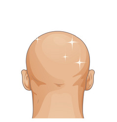 Hair Loss Stages Of Alopecia Man Problem