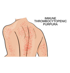 Skin Lesions In Thrombocytopenic Purpura