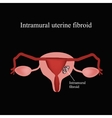 Intramural fibroids Endometriosis Infographics Vector Image