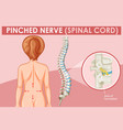 diagram showing pinched nerve in human vector image