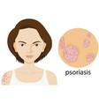 woman with psoriasis on poster vector image vector image