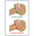 snoring and sleep apnea about health care vector image