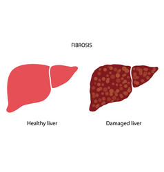 Liver disease concept Royalty Free Vector Image