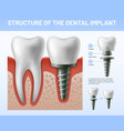 Dental teeth implant implantation procedure or Vector Image