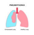 Pneumothorax hemothorax and hemopneumothorax Vector Image