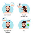 hair transplantation design concept vector image