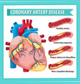 Coronary artery disease icon Royalty Free Vector Image