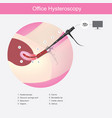office hysteroscopy showing doctors use vector image vector image