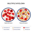 multiple myeloma close-up of healthy bone marrow vector image vector image