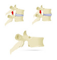 spine lumbar vertebra facet syndrome advanced vector image